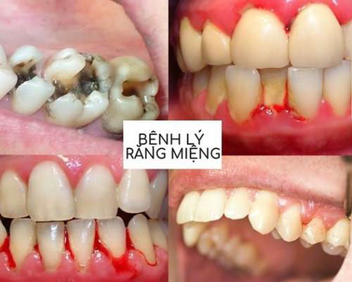 Bệnh lý răng miệng gây chảy máu chân răng