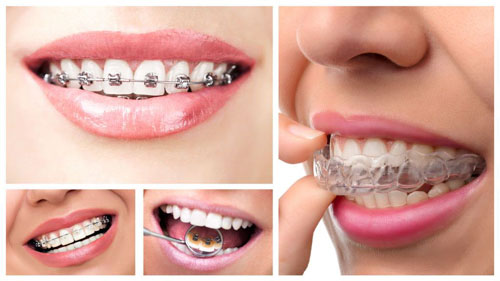Bệnh nhân có thể lựa chọn đa dạng các phương pháp niềng răng hô