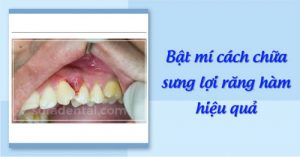Read more about the article Bật mí cách chữa sưng lợi răng hàm hiệu quả