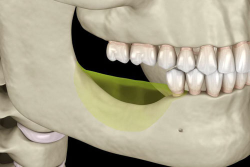 Biểu hiện của tiêu xương hàm là sự suy giảm về mật độ, chiều cao và số lượng xương