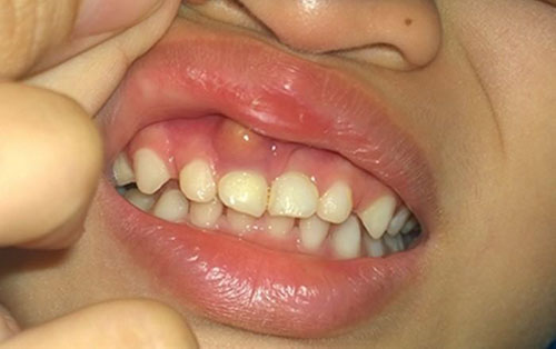 Biểu hiện sưng mộng răng thường thấy