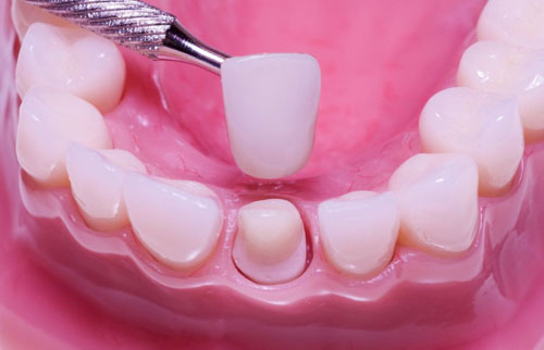Bọc răng sứ cải thiện tình trạng răng nhiễm màu