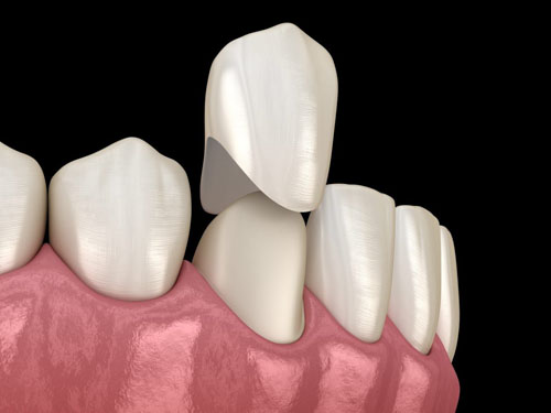 Bọc răng sứ giúp khắc phục tình trạng khớp cắn ngược ở mức độ nhẹ