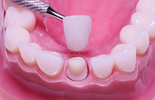Bọc răng sứ khắc phục răng sứt mẻ