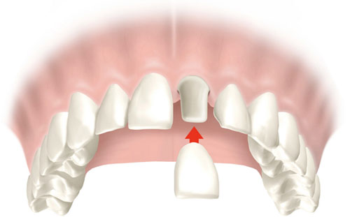 Bọc răng sứ khắc phục tình trạng thiểu sản men răng