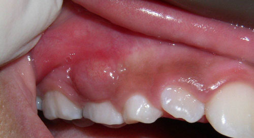 Các dạng áp xe, viêm chân răng thường gặp