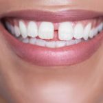 Cách trị răng thưa tại nhà có hiệu quả không?