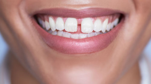 Cách trị răng thưa tại nhà có hiệu quả không?