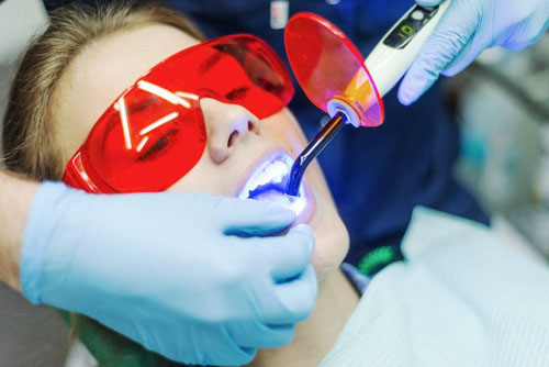 Cải thiện thiểu sản men răng bằng phương pháp trám răng thẩm mỹ