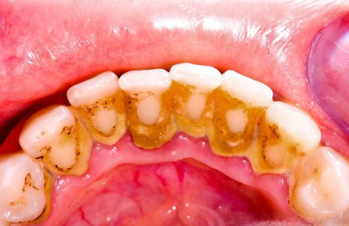 Cao răng bám chắc vào thân răng và dưới nướu
