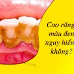 Cao răng màu đen: tác hại và cách xử lý triệt để