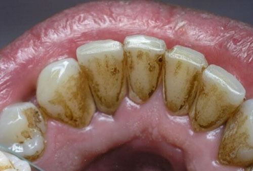Cao răng màu đen bám trên bề mặt răng và dưới nướu