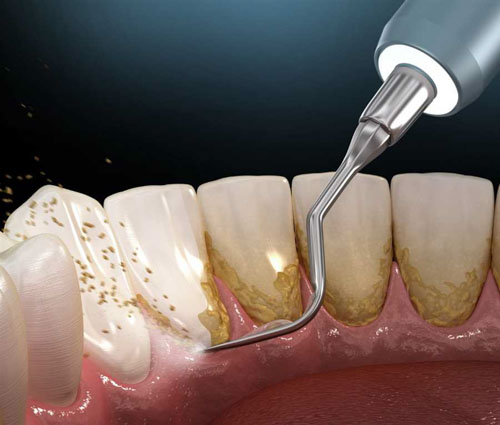 Cạo vôi răng chỉ có ý nghĩa về mặt làm sạch cho răng