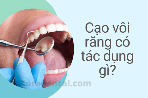 Read more about the article Cạo vôi răng có tác dụng gì? Có ảnh hưởng gì không?