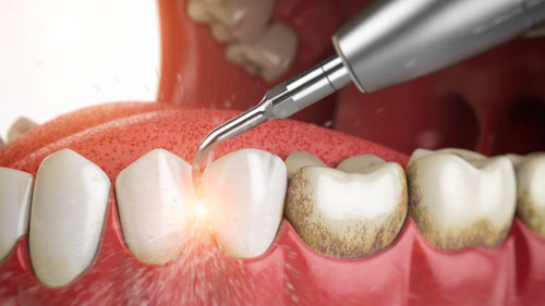 Cạo vôi răng khắc phục tình trạng chân răng bị đen
