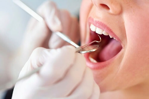Cạo vôi răng tại nha khoa là giải pháp an toàn và hiệu quả