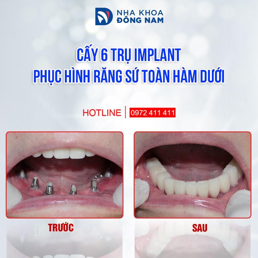 cay-6-tru-implant-phuc-hinh-rang-su