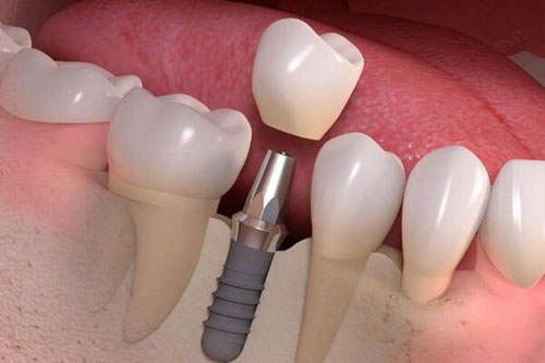 Cấy ghép Implant trong trường hợp không thể bảo tồn chiếc răng bị sứt mẻ