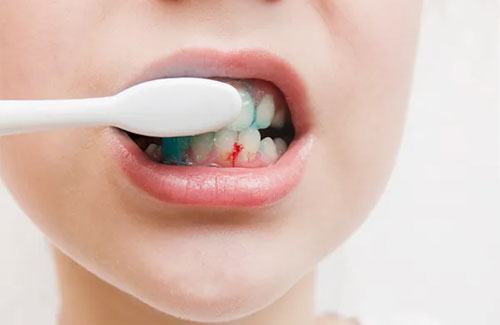 Chải răng mạnh gây chấn thương