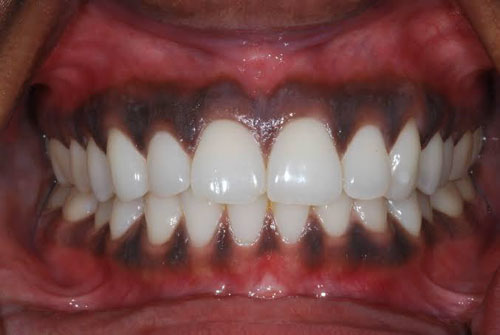 Chân nướu răng bị đen có thể xuất phát từ yếu tố di truyền