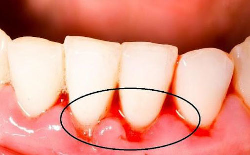 Chảy máu chân răng ở bà bầu là dấu hiệu cảnh báo những bệnh nào?