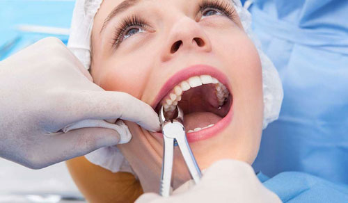 Chỉ định nhổ răng cho trường hợp thân răng bị gãy sát nướu