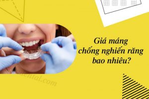 Read more about the article Máng chống nghiến răng giá bao nhiêu? Mua ở đâu?