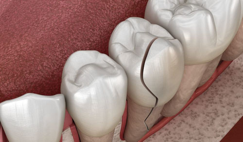 Chia thân răng là biểu hiện nặng nhất của nứt răng