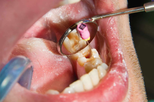 Chữa tủy cho chiếc răng bị sâu cấp độ 3