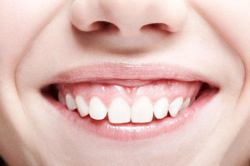 Cười hở lợi do xương hàm trên phát triển quá mức