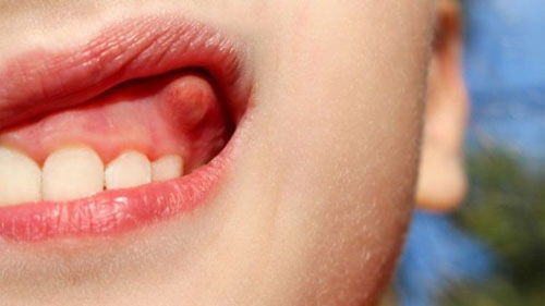 Dấu hiệu nhận biết tình trạng viêm chân răng có mủ