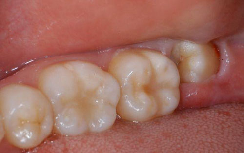 Dấu hiệu nhận biết viêm lợi trùm răng khôn khi mang bầu
