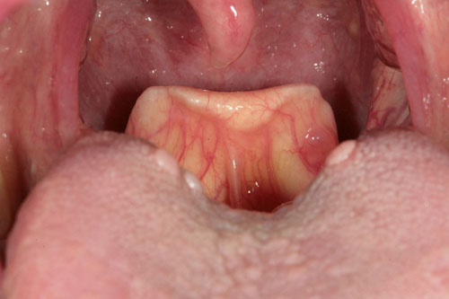 Đau họng khi nuốt nước bọt có thể là dấu hiệu của viêm nắp thanh quản