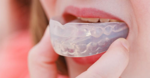 Đeo máng chống nghiến để hạn chế tổn thương do nghiến răng gây ra