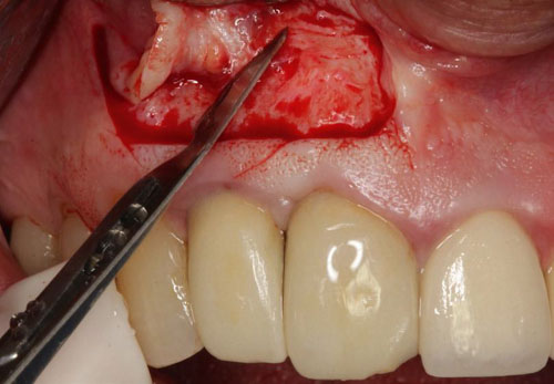Điều trị loại bỏ nang răng bảo tồn răng thật