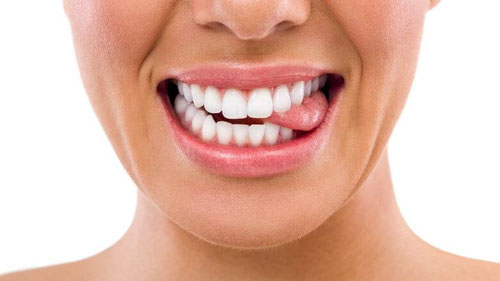 Đính đá lên răng được áp dụng cho trường hợp răng trắng sáng đều màu