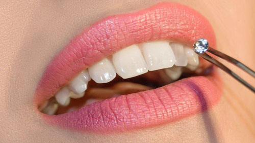 Đính đá lên răng không cần khoan lỗ giúp bảo tồn răng thật tối đa