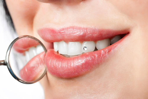 Đính đá lên răng là hình thức nha khoa thẩm mỹ rất phổ biến