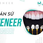 Giá răng sứ Veneer là bao nhiêu?