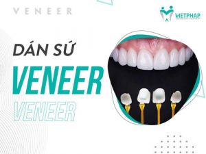 Read more about the article Giá răng sứ Veneer là bao nhiêu?