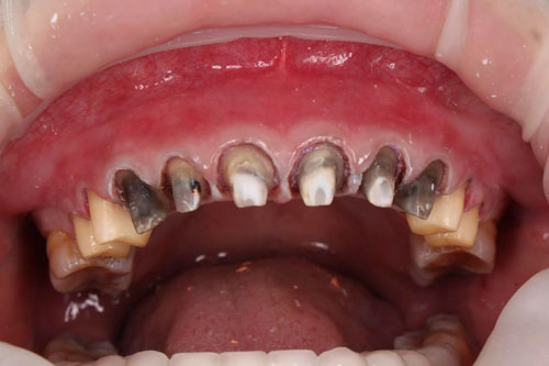 Hậu quả của việc bọc răng sứ giá rẻ kém chất lượng