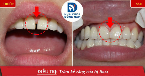 Hình ảnh bệnh nhân điều trị trám kẻ răng cửa bị thưa