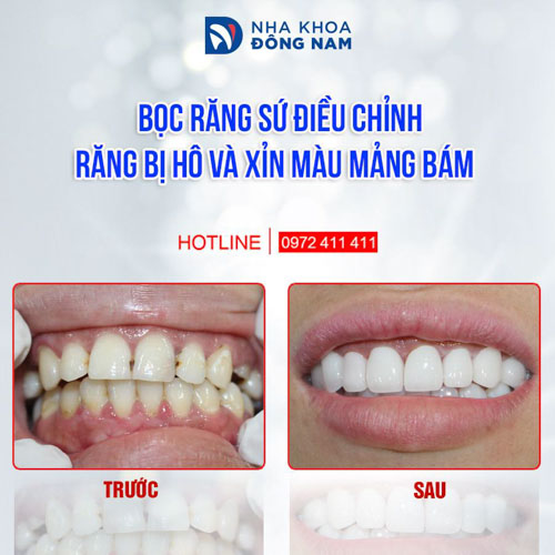 Hình ảnh bọc răng sứ cho bệnh nhân bị hô nhẹ, răng xỉn màu mảng bám