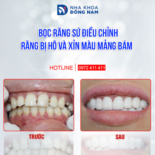 Hình ảnh bọc răng sứ cho bệnh nhân có răng hô mức độ nhẹ