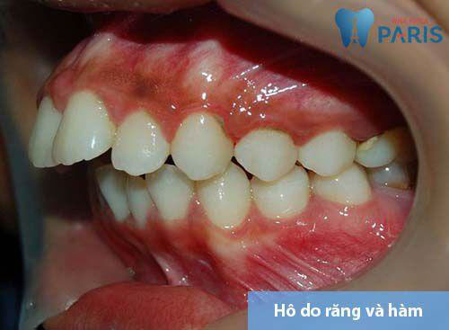Hình ảnh hô vừa do răng, vừa do hàm
