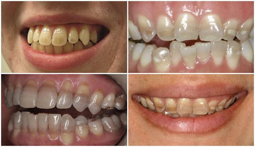 Hình ảnh răng nhiễm màu kháng sinh Tetracycline