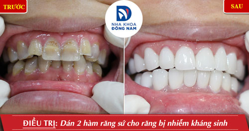 Hình ảnh thực tế dán răng sứ cho trường hợp răng nhiễm kháng sinh