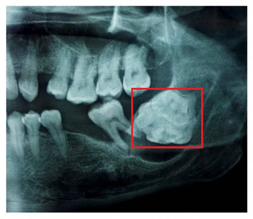 Hình chụp x-quang u răng phức hợp