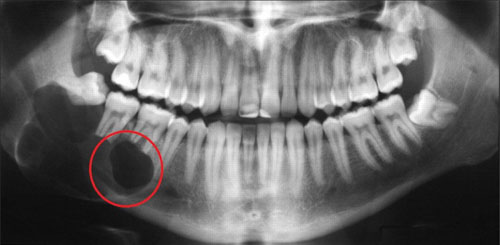 Hình X - Quang tình trạng nang chân răng