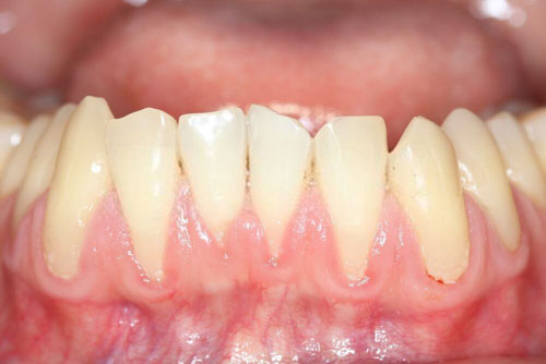 Hở chân răng gây chảy máu và khiến kích thước răng dài hơn